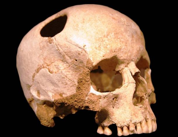 Cráneo Trepanated del Neolítico