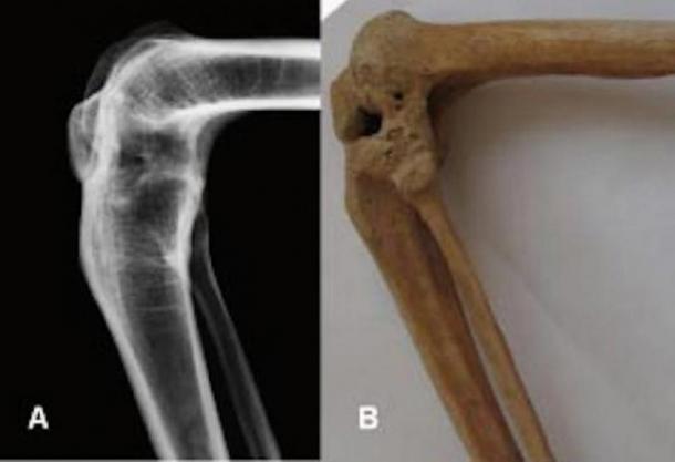 De rayos X y una fotografía del anquilosado rodilla flexionada a la izquierda del propietario prótesis. 