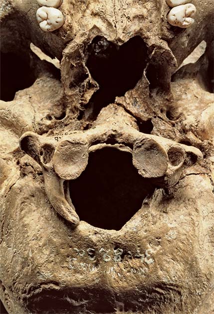 Additional research of the Bad Dürrenberg shaman revealed that the base of her skull had an anomaly which would have caused triggered involuntary twitching. (State Office for Heritage Management and Archaeology Saxony-Anhalt / CC BY-NC-ND 4.0 DEED)