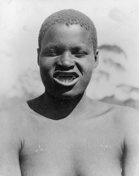 The Batonga people of Zambia removed their front upper teeth entirely as a sign of beauty. (Wellcome Images / CC BY 4.0)