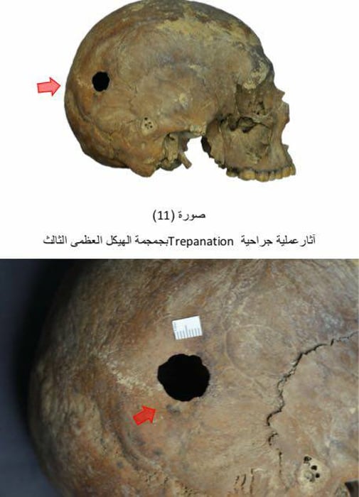 Evidence of trepanation on a skull. (Image: Ministry of Antiquities)