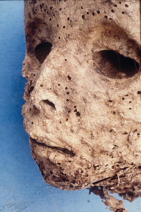 Pockmarks are visible on the face of the child mummy.