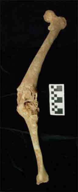 The male in Tomb I exhibits a fused left knee with clear external rotation of the tibia, evident from the anticlockwise twist caused by a penetrating lance positioned obliquely from the right side of the photo. (Antonis Bartsiokas et al. / Journal of Archaeological Science)