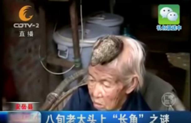 87-year-old Liang Xiuzhen from Sichuan, China had a five inch HORN growing out of her head. (Youtube Screenshot)