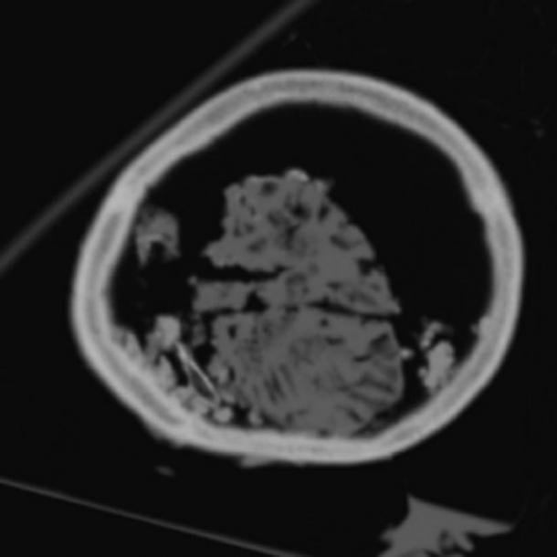 Sección de tomografía computarizada del cráneo que muestra dos de los fragmentos más grandes, que pueden ser los hemisferios cerebrales separados por la hendidura sagital.  (David King)
