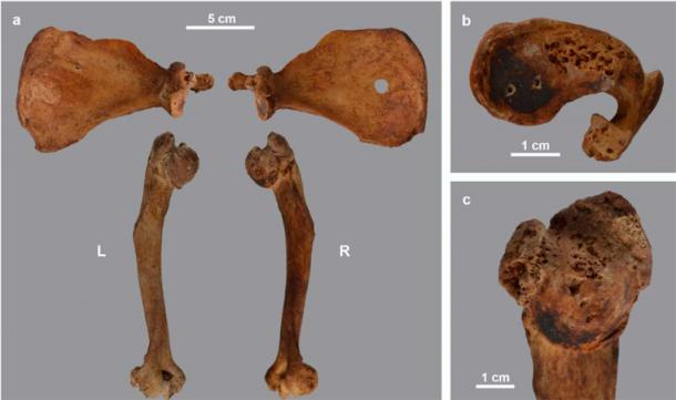 Deformations in the arm skeleton of male baboon, showing bent bones and deformed bones and pitting. (Van Neer et al./ PLoS ONE)