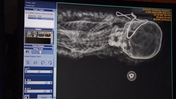 Driscoll Children’s Hospital X-ray of the mummy confirms age, gender and even cause of death