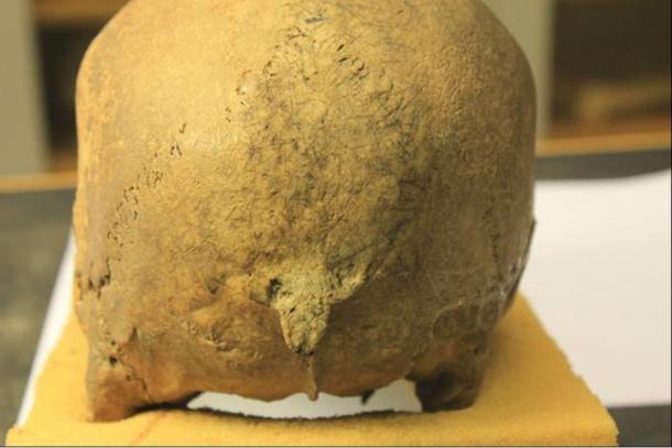 From the Viking skeletal study: Antemortem damage is observable with remodeling of the occipital bone.