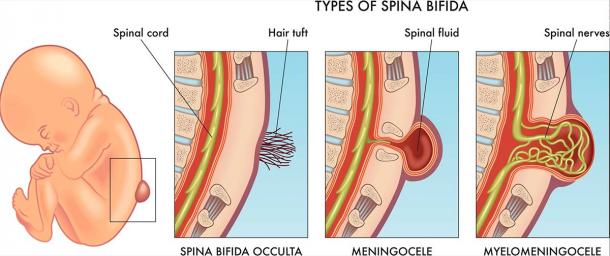 Medical illustration of infant spina bifida with annotation. Source: rob3000 / Adobe Stock.