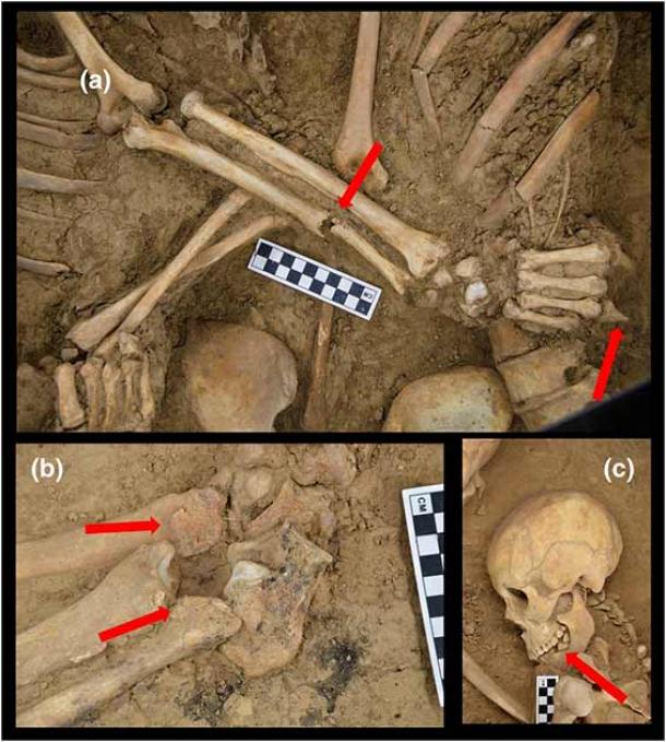 Pathological and trauma signs on the lovers’ skeletons: (a) An unhealed ulnar fracture and missing part of the fourth digit on the right hand of the male individual. Slight development of the marginal osteophytes on the lumbar vertebrae could be detected in the female skeleton; (b) Osteophytosis on the distal end of the lower limbs of the male individual; (c) Antemortem tooth loss in the female individual. (International Journal of Osteoarchaeology)