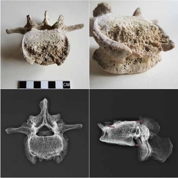 Photography and digital radiograph of the fourth lumbar vertebra (L4) affected by tuberculous spondylodiscitis of the Pompeii man. (Scorrano et. al. / CC BY 4.0)