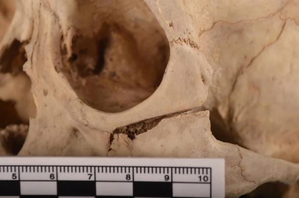 Close up of the injuries sustained by the Shiyanzi man which experts believe proove that he was a victim rather then the perpetrator of a crime. (Zou et. al. / Archaeological and Anthropological Sciences)