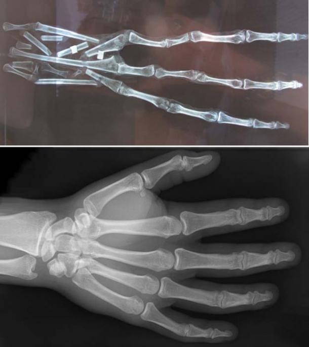 Top: X-ray of the 3-fingered hand, showing 6 bones in each finger. Credit: Brien Foerster / Hidden Inca Tours. Bottom: X-ray of a human hand, showing 3 bones in each finger.