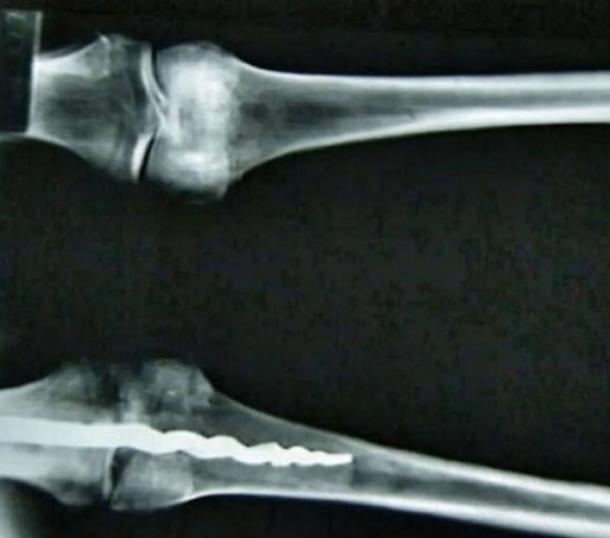 Radiografía que muestra el taladro de 9 pulgadas en la rodilla de Usermontu