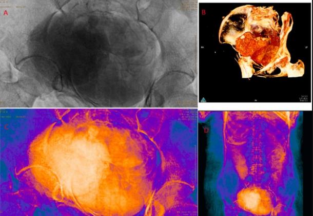 Los escáneres de la momia embarazada revelaron un feto momificado, como se ve en estos escáneres abdominales de sus restos.  (Proyecto de la Momia de Varsovia / Revista de Ciencias Arqueológicas)