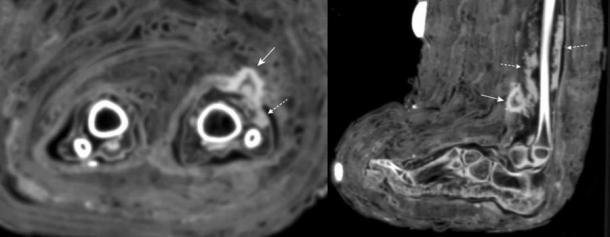 CT scans of soft tissue infection in the lower leg of the child mummy. The scan reveals a mass consistent with dried pus (indicated with dotted arrows) below the bandage. (Panzer et. al / International Journal of Paleopathology)