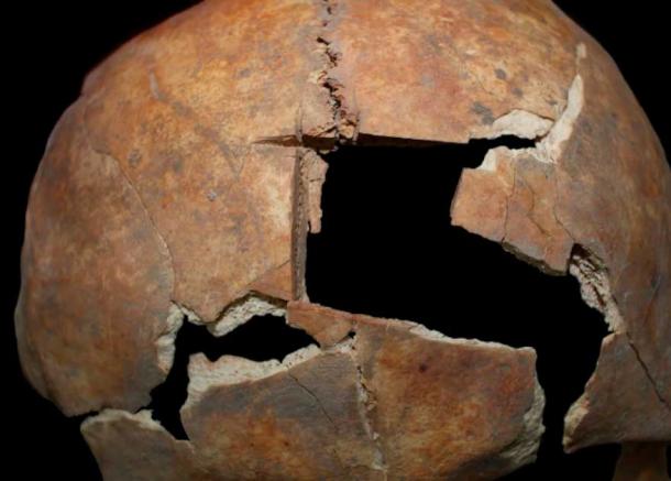 The skull showing evidence of angular notched trephination from Megiddo. (Kalisher, R et al / PLoS ONE)