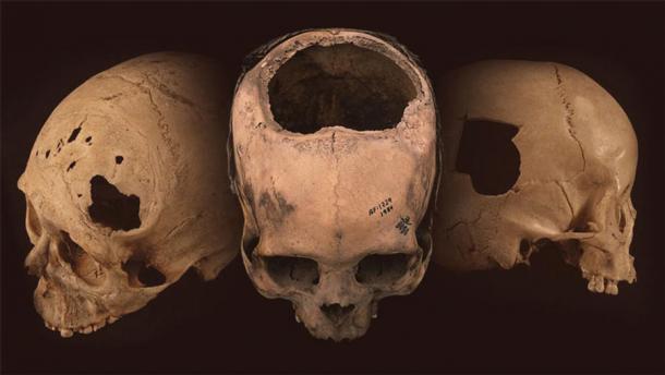 Ancient skulls bearing evidence of trepanation, a kind of skull surgery in which a telltale hole was surgically cut into the cranium, evidence for which can be found in Peru. (University of Miami)