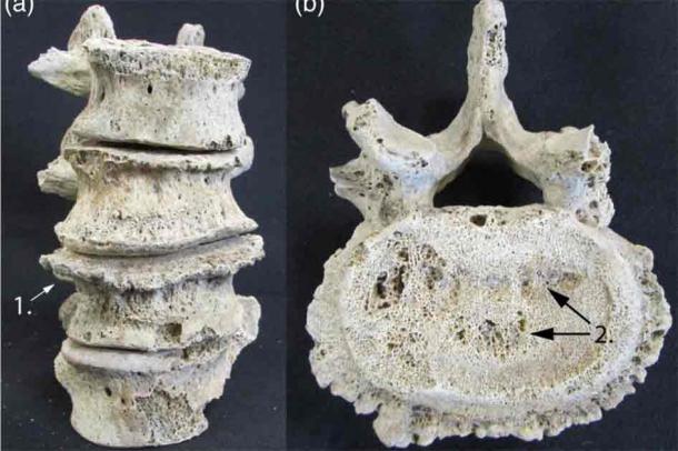 The spine of the lady, showing degeneration which suggests a rigorous and hard-working life. (Bournemouth University)