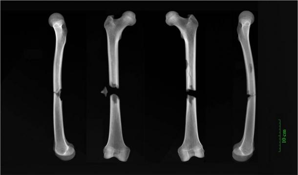 X-rays of butterfly fractures to both femora of an adult male buried in the Augustinian friary in medieval Cambridge. (Dr. Jenna Dittmar / University of Cambridge)